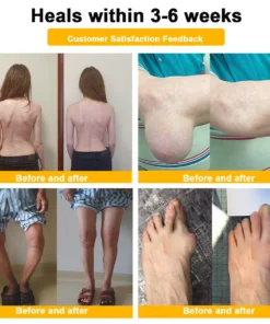 ODALIT™ Botulinum Toxin & Bee Venom Pain-Relief Bone Healing Cream