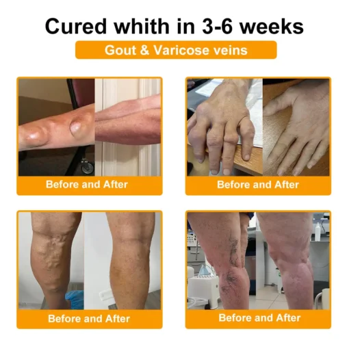 ODALIT™ Botulinum Toxin & Bee Venom Pain-Relief Bone Healing Cream