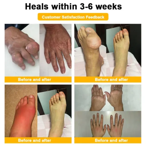 ODALIT™ Botulinum Toxin & Bee Venom Pain-Relief Bone Healing Cream
