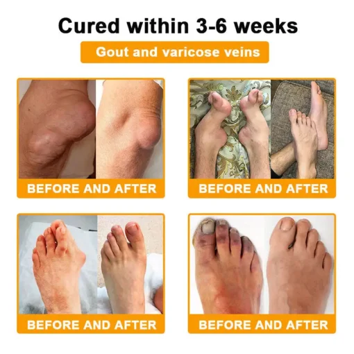 ODALIT™ Botulinum Toxin & Bee Venom Pain-Relief Bone Healing Cream