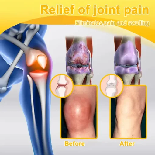 ODALIT™ Botulinum Toxin & Bee Venom Pain-Relief Bone Healing Cream