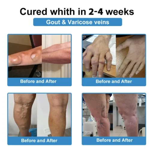 ODALIT™ Nano-microneedle joint patch