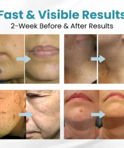 ODALIT™ Non-Invasive Mole and Wart Removal Laser Pen