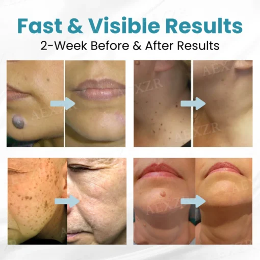 ODALIT™ Non-Invasive Mole and Wart Removal Laser Pen