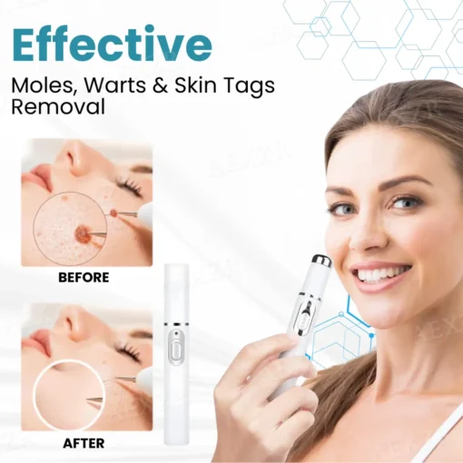 ODALIT™ Non-Invasive Mole and Wart Removal Laser Pen