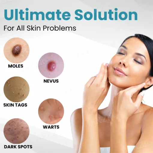 ODALIT™ Non-Invasive Mole and Wart Removal Laser Pen