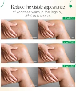 ODALIT™ Vein Therapy Cream