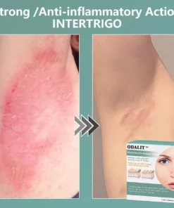 ODALIT™ MicroNeedle Botanic skin Tag Removal Patch