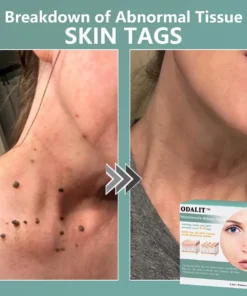 ODALIT™ MicroNeedle Botanic skin Tag Removal Patch