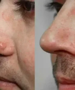 ODALIT™ Natural Skin Tag and Wart Removal Patches