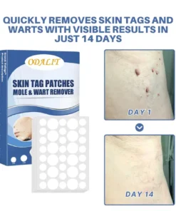 ODALIT™ Natural Skin Tag and Wart Removal Patches