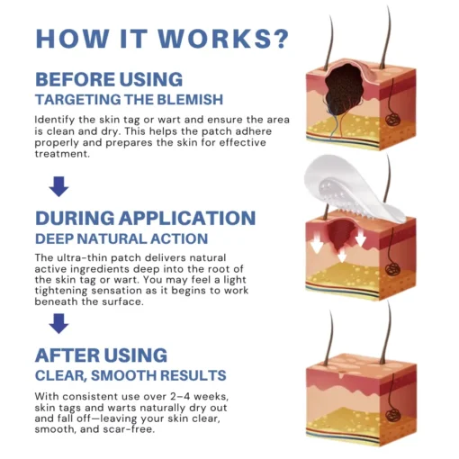ODALIT™ Natural Skin Tag and Wart Removal Patches
