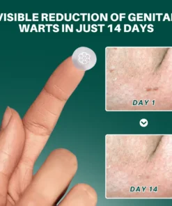 ODALIT™ Genital Wart Removal Patch