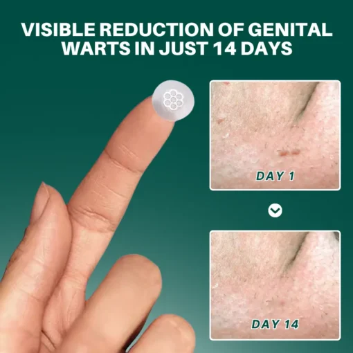 ODALIT™ Genital Wart Removal Patch