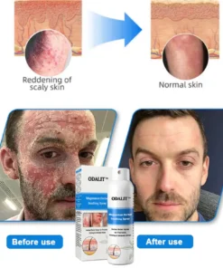 ODALIT®Magnesium Herbal Psoriasis Spray