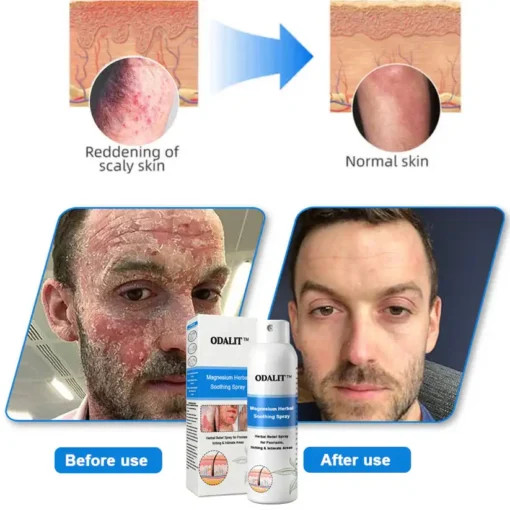 ODALIT®Magnesium Herbal Psoriasis Spray