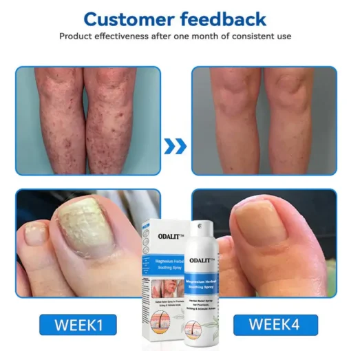 ODALIT®Magnesium Herbal Psoriasis Spray
