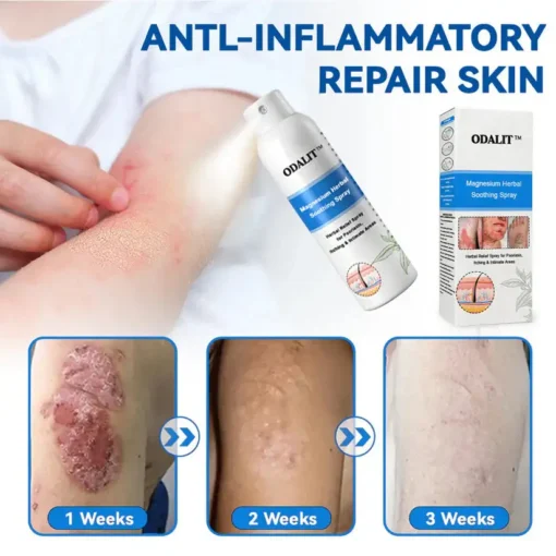 ODALIT®Magnesium Herbal Psoriasis Spray