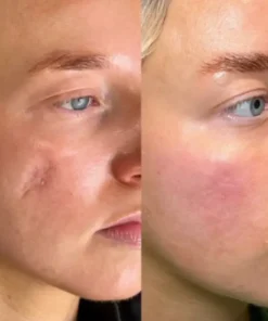 ODALIT™ Silicon ScarStick