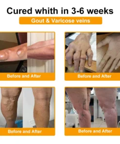 ODALIT™ Botulinum Toxin & Bee Venom Pain-Relief Bone Healing Cream 2026