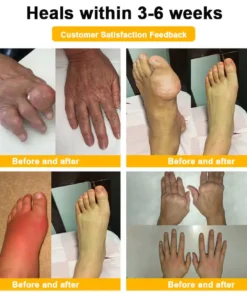 ODALIT™ Botulinum Toxin & Bee Venom Pain-Relief Bone Healing Cream 2026