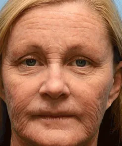 ODALIT™ Peptide-Infused Firming Shot , Dermatologist-Approved Formula for Powerful Lifting Visibly De-puffing