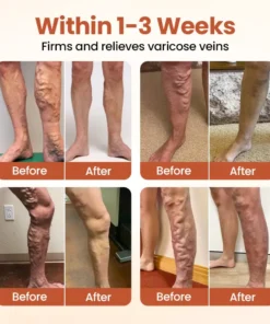 ODALIT™ VeinTarget Microneedle Patch